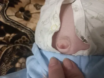 Фунгус пупка у новорожденного ребёнка | Пикабу
