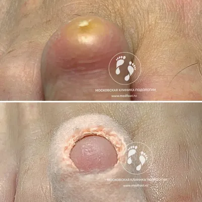 Story of wart removal 🌸 Dynamics from SEVERAL SESSIONS 🌸 Pedicure with  preparations 🌸 Eng. SUBTITLES - YouTube