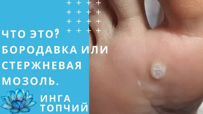 МОЗОЛЬ или БОРОДАВКА? Как отличить?|Опасность|Medped | Medped.ru | Дзен