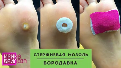 Kernel callus OR wart? 🌸 WHAT HAPPENS if you self-medicate 🌸 Irina  Brilyova (English SUBTITLES) - YouTube