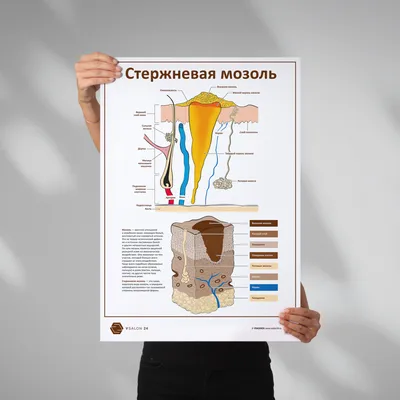 Стержневая мозоль (версия 2, плакат) ᐈ купить по низкой цене в  интернет-магазине VSALON24