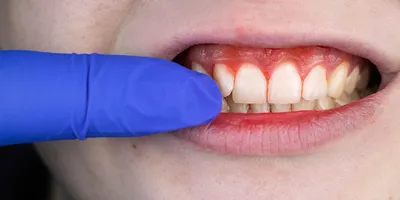Изображения стоматита десен для врачей-стоматологов