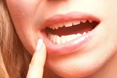 Как лечить стоматит у детей – статьи детской стоматологической клиники  «Мартинка»