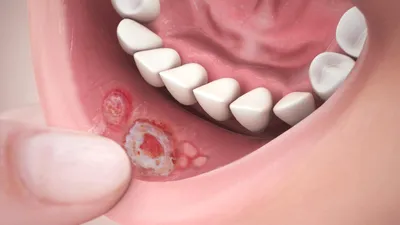 Как лечить стоматит у детей советы опытных стоматологов
