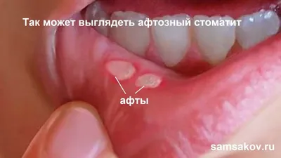 Стоматит: лечение, симптомы, виды, признаки у взрослых и детей