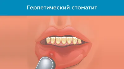 Афтозный стоматит: симптомы, причины и лечение - Альянс бьюти-стоматологов,  Москва