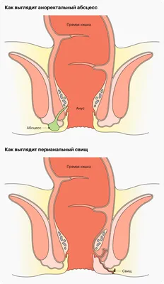 Трещины и шишки при геморрое - причины появления и методы лечения