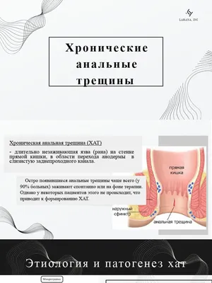 Анальная трещина: что это, симптомы, причины, лечение трещин в заднем  проходе, профилактика