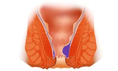Свечи от анальных трещин - лечение в Москве, запись на прием и консультацию  к проктологу