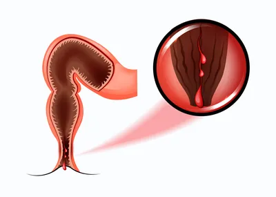 Хроническая анальная трещина - лечение в Москве, запись на прием и  консультацию к проктологу