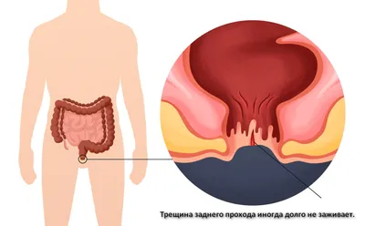 Анальная трещина, как выявить и вылечить болезнь