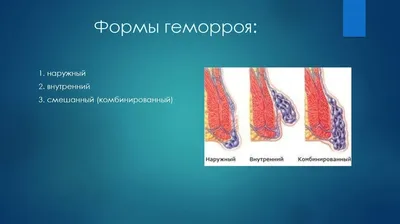 Лечение анального сторожевого бугорка в Иркутске | Запись на прием и цены  лечения в отделении платной проктологии