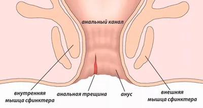 Анальная трещина, лечение - Медицинский центр \"На Восточной\"