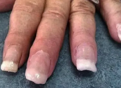 Эти опасные заболевания можно выявить по изменениям ногтей