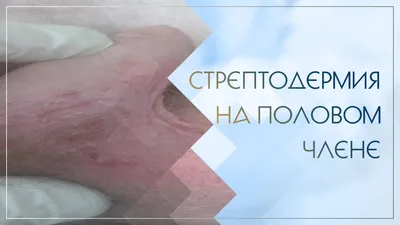 Стрептодермия на половом члене. Клинический случай №9 - YouTube