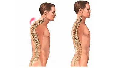 Межпозвоночная грыжа шейного отдела — International Lumbago Clinic