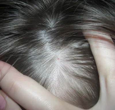 Прыщи, гнойники, болячки, болезни кожи головы | Блог IHC Clinic