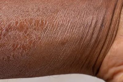 Ихтиоз: что это за болезнь кожи, лечение симптомы, причины, виды
