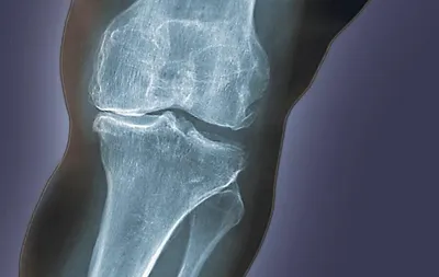 Суставная мышь: особенности в коленном суставе и диагностика на рентгене