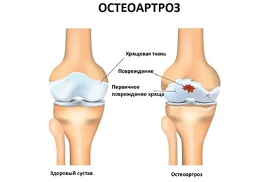 Расшифровка МРТ коленного сустава. Разрастание внутренней выстилки  синовиальной оболочки с её утолщением и гиперпродукцией синовиальной  жидкости. Хондромные тела в полости переднего заворота суставной сумки |  Второе мнение