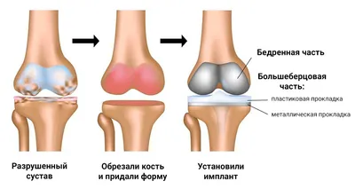 Шов мениска коленного сустава | Скандинавский Центр Здоровья | Дзен