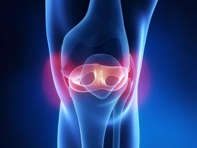 Артроз коленного сустава (гонартроз) - симптомы, степени и лечение