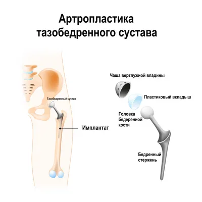 Хондроматоз в Москве | Клиника «Ваш Доктор»
