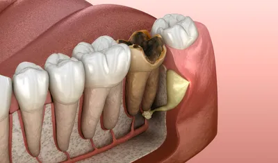 Зубной свищ на десне: причины, симптомы и лечение в стоматологической  клинике