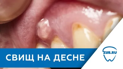 Свищ на десне – причины, симптомы, лечение в Москве - цены, отзывы в  стоматологических клиниках Зуб.ру