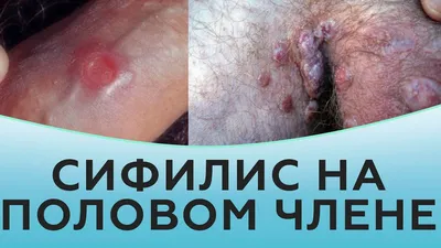 Сыпь на гениталиях у мужчин фото фотографии