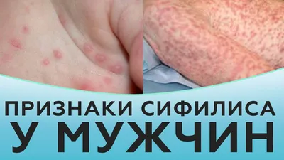 Герпес простой — Derma.ua