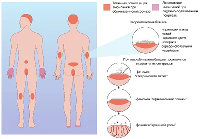 Псориаз - что это, симптомы, лечение и профилактика - FitoBlog