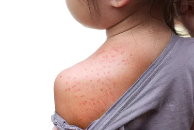 Сыпь на плечах и предплечьях: причины, симптомы и лечение