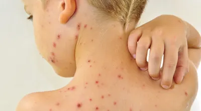 Сыпь на коже и отеки: причины, симптомы и лечение