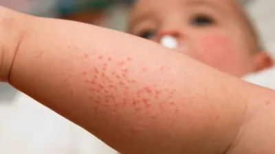 Кожные высыпания у малышей − противопоказания к вакцинации - статьи от  специалистов клиники «Мать и дитя»