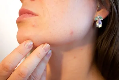 Медики перечислили 7 необычных ранних симптомов рака кожи - Российская  газета