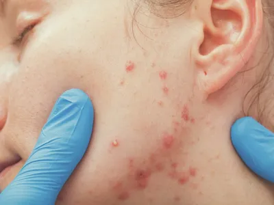 Высыпания на коже у детей | Городской кожно-венерологический диспансер