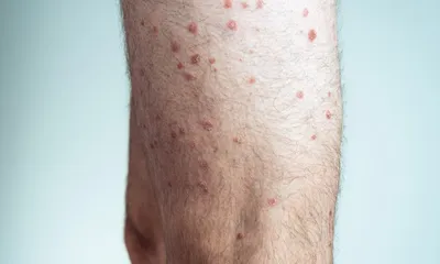 Аллергия Как распознать и лечить