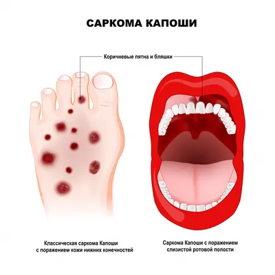 Саркома Капоши - симптомы острой и хронической форм, стадии и признаки у  мужчин и женщин, причины появления, диагностика и лечение заболевания