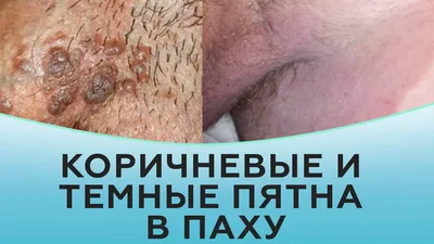Лечение паховой эпидермофитии в Киеве ≡ Блог MED CITY | Паховая  эпидермофития у мужчин и женщин