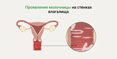 Половой псориаз у женщин и мужчин: лечение псориаза на половых органах