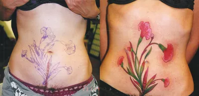Татуировка - «Перекрытие шрама после лапаротомии на животе и мой лев на  руке 🦁 на этом не остановлюсь. Больно ли бить тату по шрамам? Где искать  идеи? Что с татуировкой через 2-3 года» | отзывы
