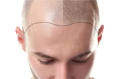 Трихопигментация головы или перманентный татуаж. Что это? - HLC - Центр  пластической хирургии и трансплантации волос