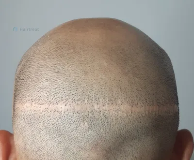 Татуаж головы для лысеющих - YouTube