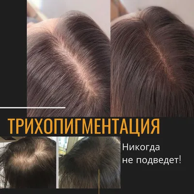 Трихопигментация или трансплантация волос? | Елена Ольшанская | Дзен