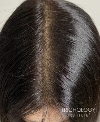 Трихопигментация / SMP- это татуаж головы, имитация волос. Не пересадка, не  лечение! Цена индивидуальна в зависимости от объема… | Instagram