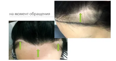 Annatattoo - Трихопигментация волос (медицинский татуаж,... | Facebook