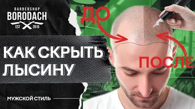 Трихопигментация головы - Центр трансплантации и лечения волос в Казани