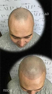 Пересадка волос и трихопигментация: эффективный тандем для коррекции  рубцовой алопеции :: Врачам-специалистам