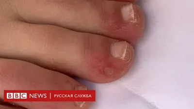 Стоит ли волноваться? Парень, 21 год. Месяца 2-3 назад обнаружил на пальце  | MedAboutMe
